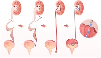 The concerns of mechanical upper urinary tract obstruction in neurogenic lower urinary tract dysfunction: Beyond augmentation cystoplasty